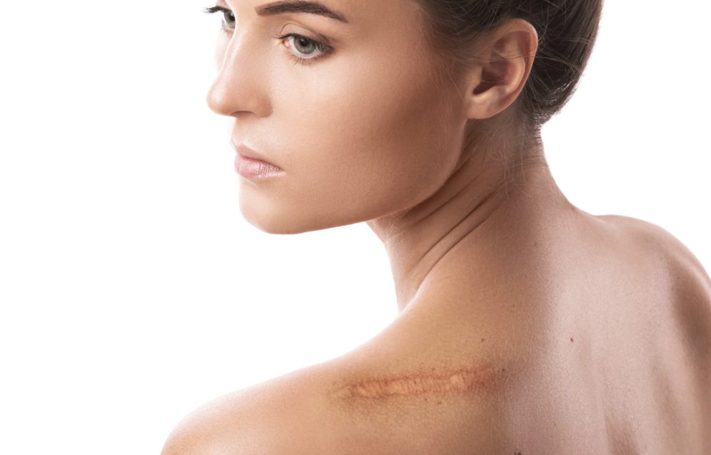 Zdjęcie przedstawiające profesjonalny zabieg redukcji blizn pooperacyjnych, mający na celu poprawę wyglądu skóry po operacjach.