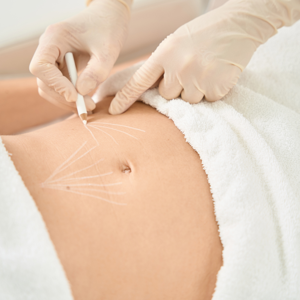 Innowacje w liposukcji – przegląd nowoczesnych technik modelowania sylwetki dla najlepszych efektów. Chirurgia plastyczna Wrocław.