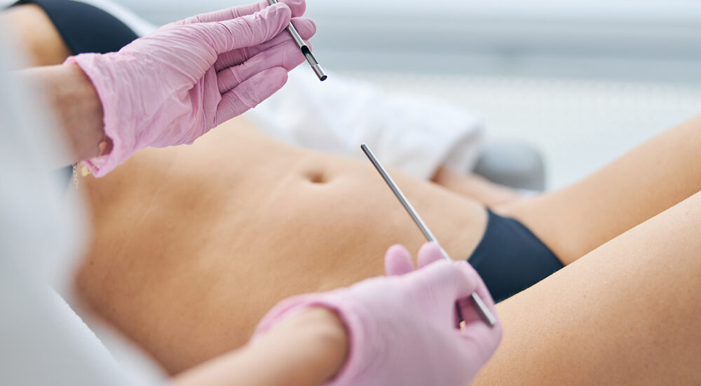 Nowoczesne podejścia w liposukcji – przegląd technik modelowania sylwetki i ocena wyników zabiegów. Chirurgia plastyczna Wrocław.