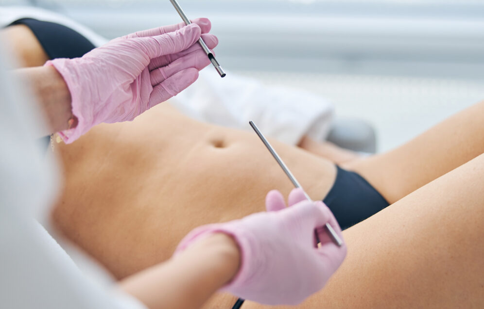 Nowoczesne podejścia w liposukcji – przegląd technik modelowania sylwetki i ocena wyników zabiegów. Chirurgia plastyczna Wrocław.