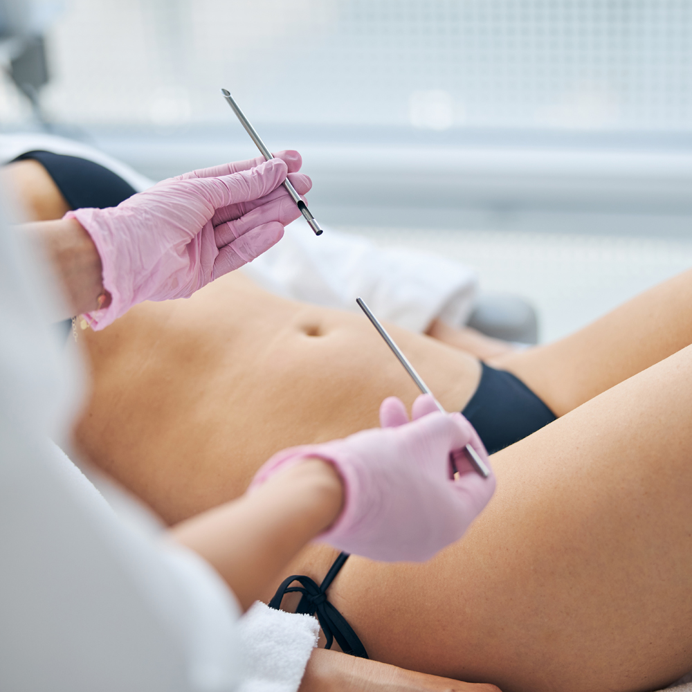 Nowoczesne podejścia w liposukcji – przegląd technik modelowania sylwetki i ocena wyników zabiegów. Chirurgia plastyczna Wrocław.