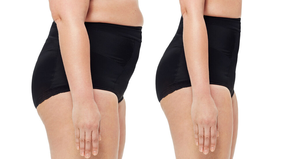 Plastyka brzucha (abdominoplastyka) – wskazania, przebieg operacji i efekty zabiegu poprawiającego sylwetkę. Chirurgia plastyczna Wrocław.