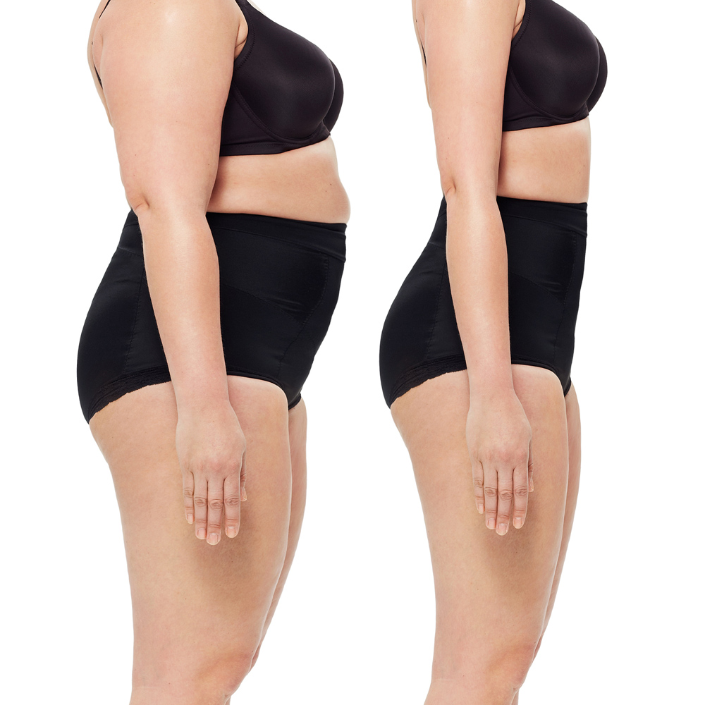 Plastyka brzucha (abdominoplastyka) – wskazania, przebieg operacji i efekty zabiegu poprawiającego sylwetkę. Chirurgia plastyczna Wrocław.