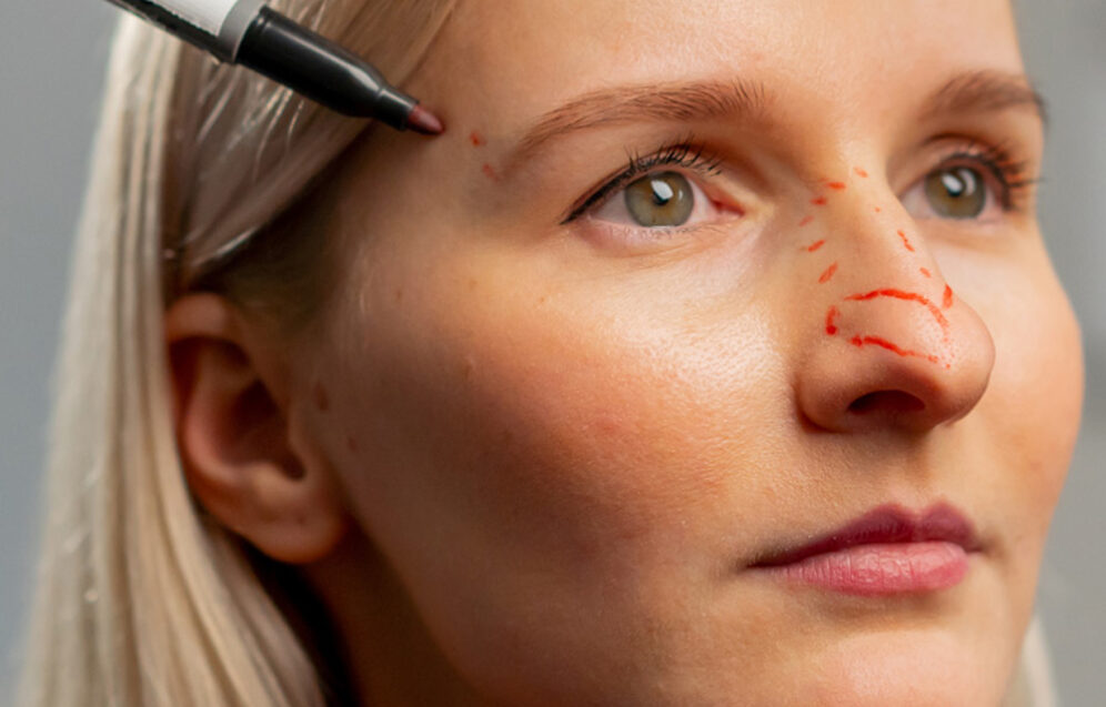 Plastyka nosa wspierająca funkcje zdrowotne – poprawa przegrody nosowej, oddychania i redukcja chrapania. Chirurgia plastyczna Wrocław.