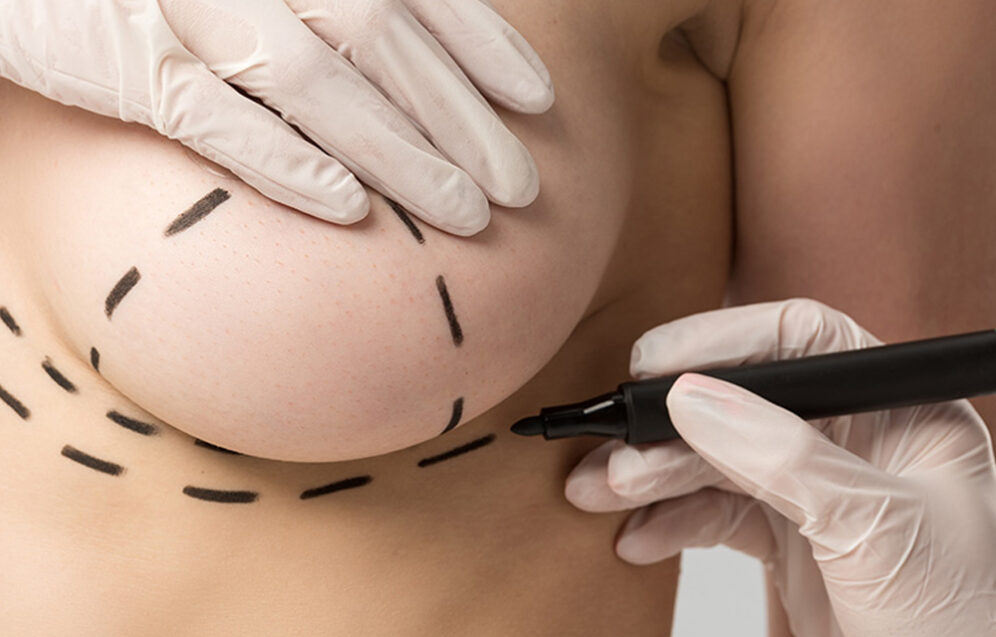 Nowoczesne implanty piersi – innowacje technologiczne zapewniające naturalny wygląd i większe bezpieczeństwo.