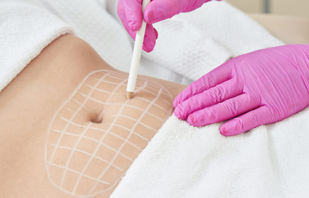 Precyzyjne zastosowanie lasera w chirurgii plastycznej – Chirurgia plastyczna Wrocław