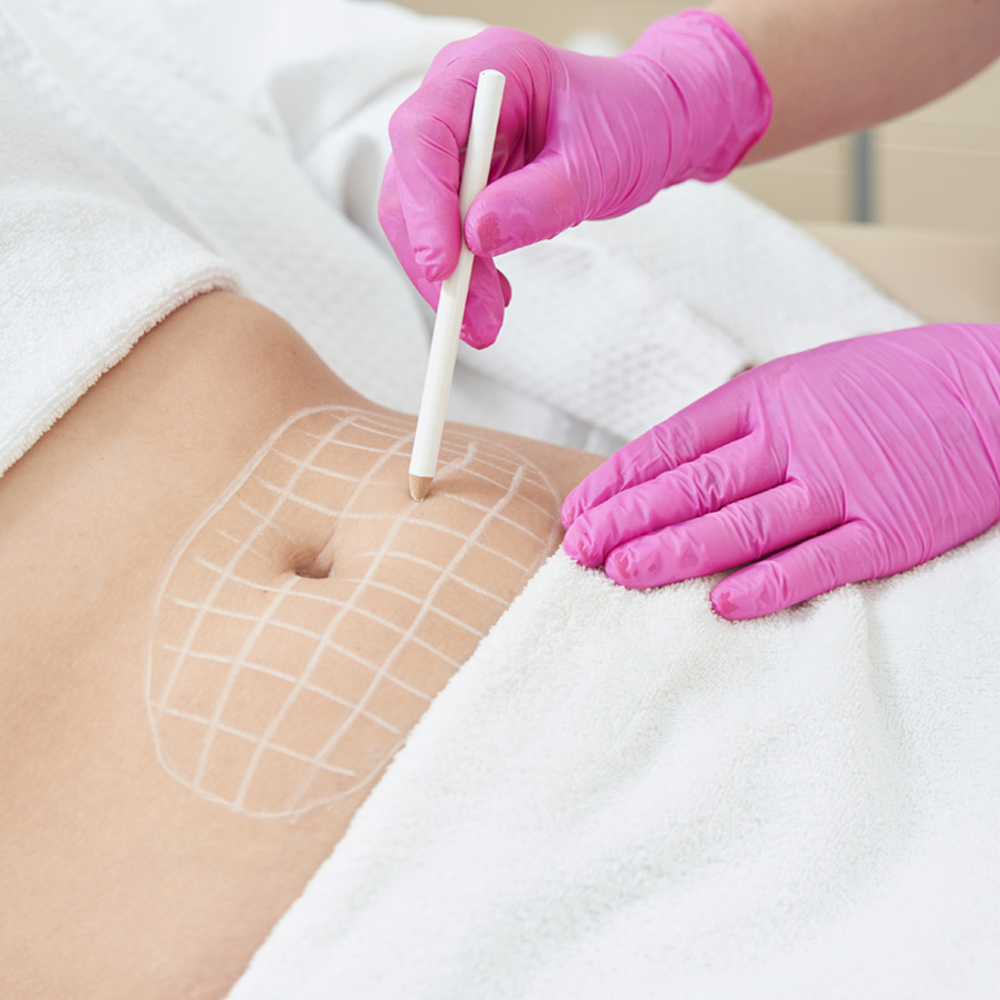 Precyzyjne zastosowanie lasera w chirurgii plastycznej – Chirurgia plastyczna Wrocław