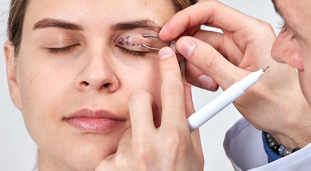 Chirurgia powiek (blefaroplastyka) – zabieg poprawiający wygląd i funkcję powiek.