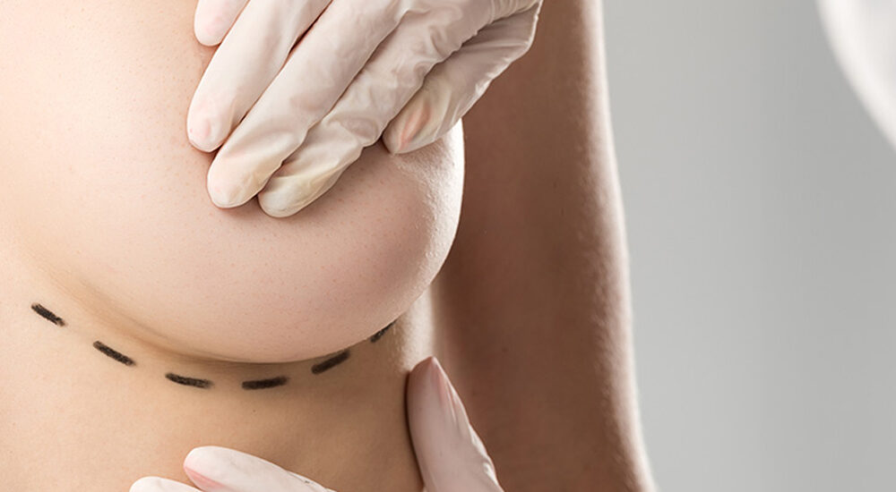 Lipofilling – przeszczep tłuszczu jako alternatywa dla implantów, analiza badań, skuteczność i trwałość wyników. Chirurgia plastyczna Wrocław.