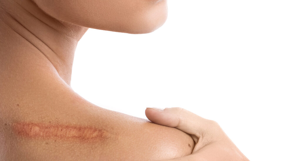 Przegląd najnowszych metod leczenia blizn – technologie, skuteczność i wyniki badań wspierające regenerację skóry. Chirurgia plastyczna Wrocław.