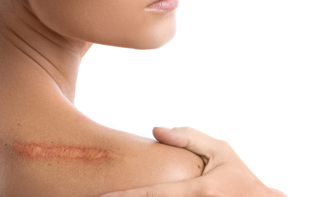 Przegląd najnowszych metod leczenia blizn – technologie, skuteczność i wyniki badań wspierające regenerację skóry. Chirurgia plastyczna Wrocław.