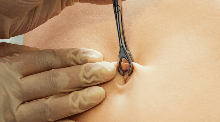 rekonstrukcja pępka