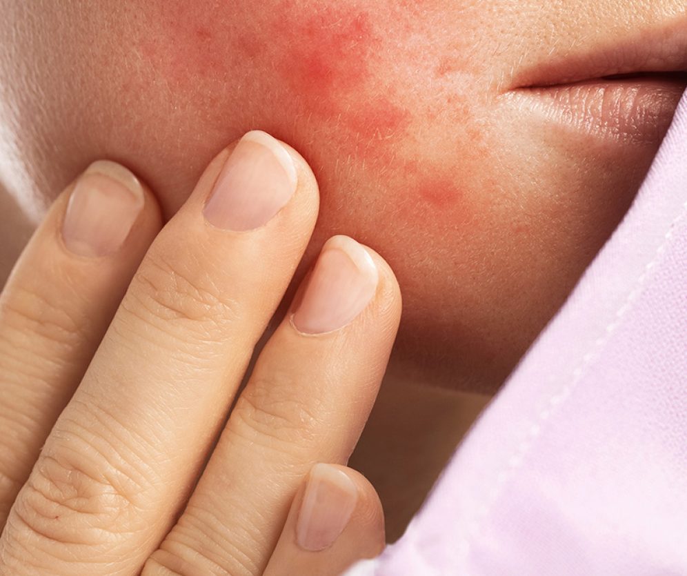 dermatologia-wroclaw-leczenie-tradzik-rozowaty-3