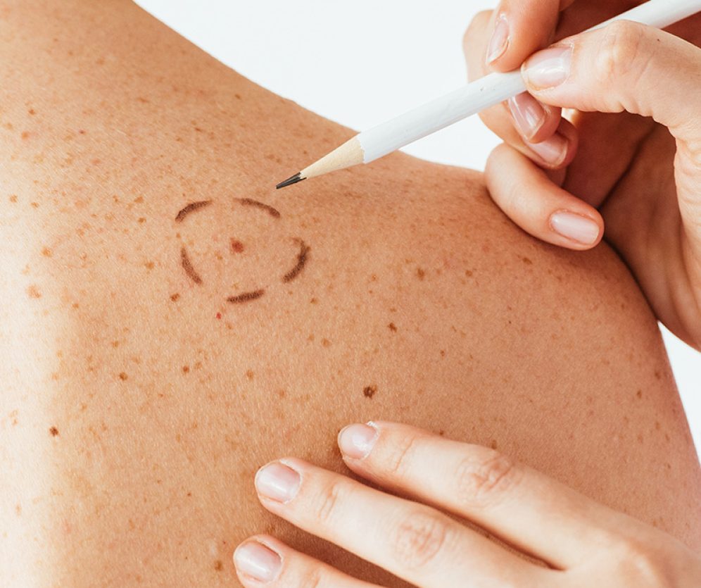 dermatologia-wroclaw-specjalistyczne-usuwanie-znamion-3