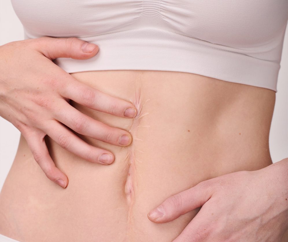 dermatologia-wroclaw-usuwanie-blizn-3